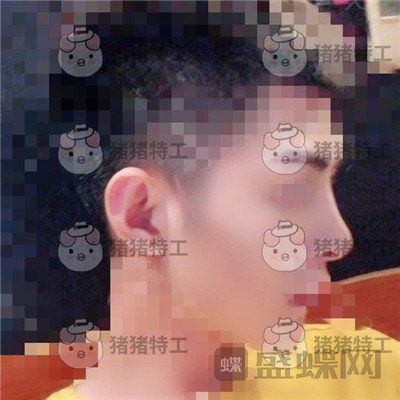 上海华美,叶丽萍,垫下巴,案例,价格,