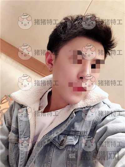 上海华美,叶丽萍,垫下巴,案例,价格,