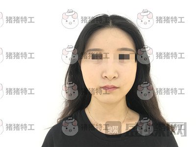 上海华美,李志海,下颌角整形,案例,价格,