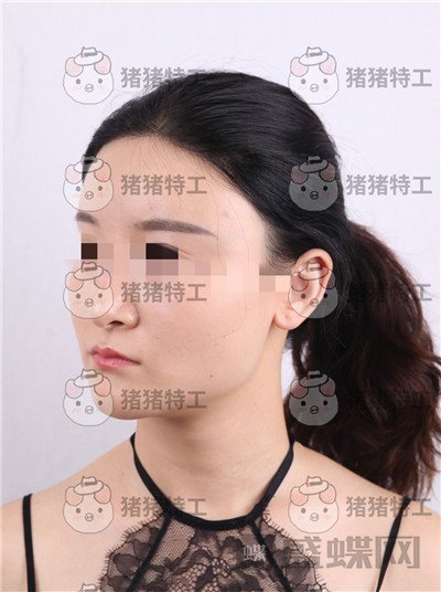 上海华美,李志海,下颌角整形,案例,价格,