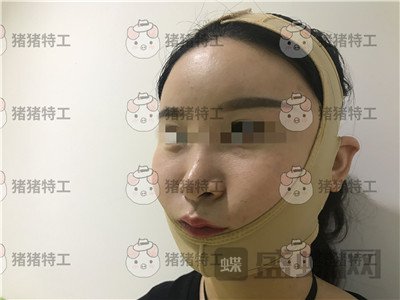 上海华美,李志海,下颌角整形,案例,价格,
