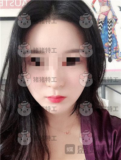 上海华美,李志海,下颌角整形,案例,价格,