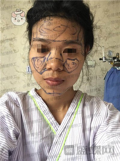 上海愉悦美联臣,陈红梅,脂肪填充,案例,价格,