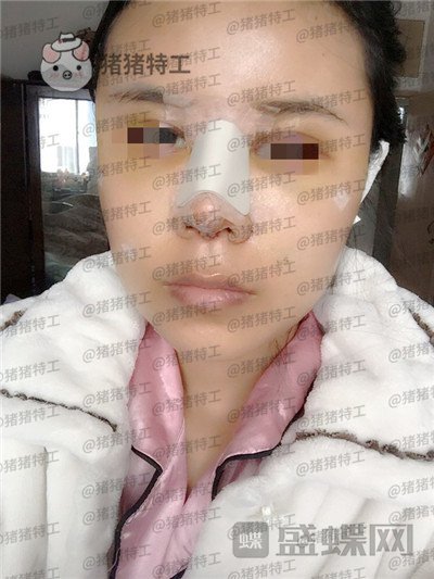 上海愉悦美联臣,陈红梅,脂肪填充,案例,价格,