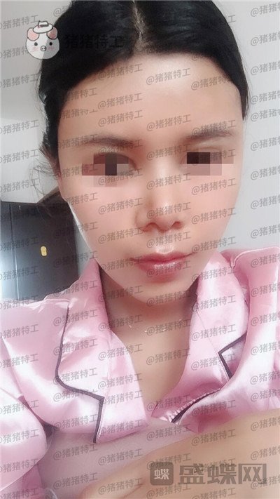 上海愉悦美联臣,陈红梅,脂肪填充,案例,价格,