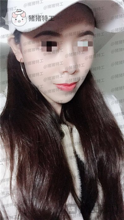 上海愉悦美联臣,陈红梅,脂肪填充,案例,价格,