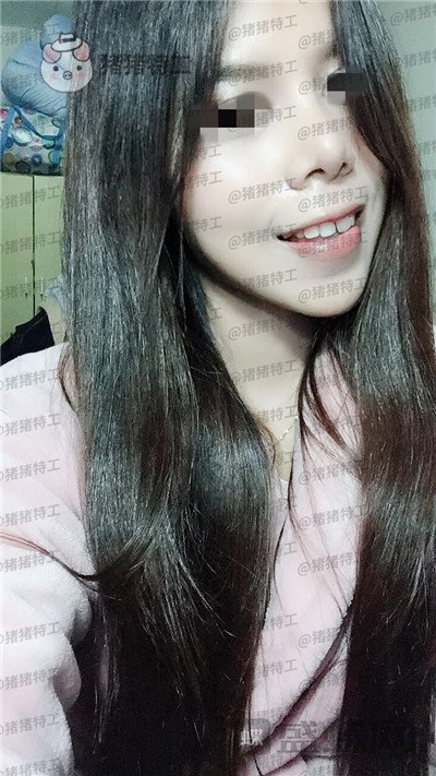 上海愉悦美联臣,陈红梅,脂肪填充,案例,价格,