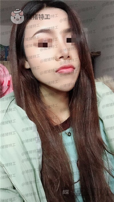 上海愉悦美联臣,陈红梅,脂肪填充,案例,价格,