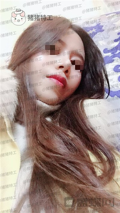 上海愉悦美联臣,陈红梅,脂肪填充,案例,价格,