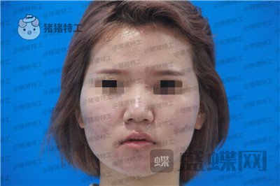 西安医学院,陈杰,鼻部手术,案例,价格,