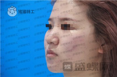 西安医学院,陈杰,鼻部手术,案例,价格,