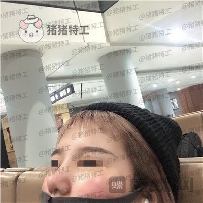 西安医学院,陈杰,鼻部手术,案例,价格,