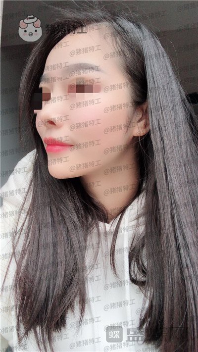 重庆铂生,杜亚旭,鼻部手术,案例,价格,