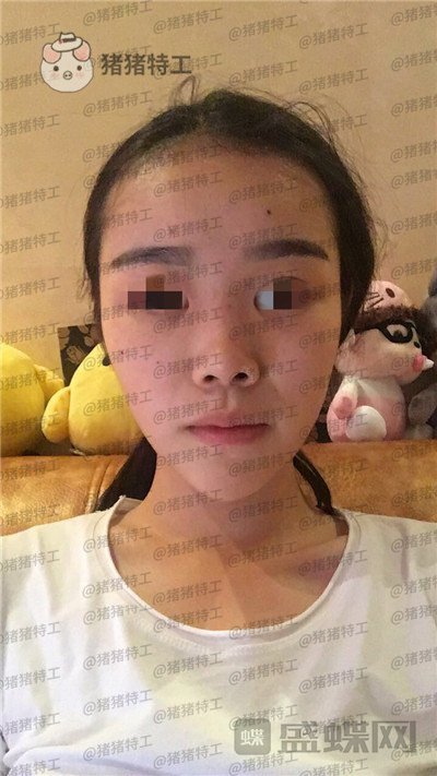 重庆铂生,杜亚旭,鼻部手术,案例,价格,