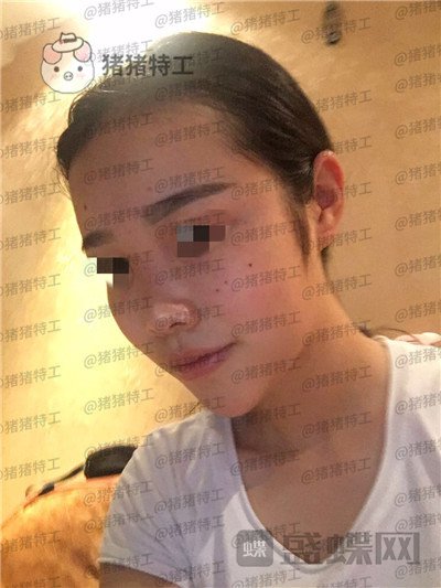 重庆铂生,杜亚旭,鼻部手术,案例,价格,