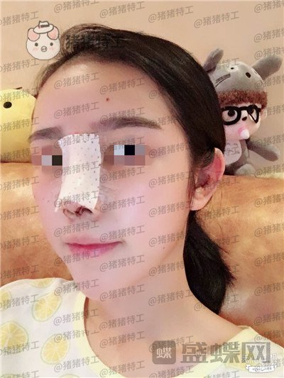 重庆铂生,杜亚旭,鼻部手术,案例,价格,