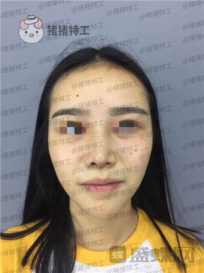 重庆铂生,杜亚旭,鼻部手术,案例,价格,