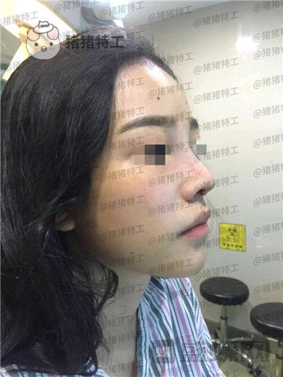 重庆铂生,杜亚旭,鼻部手术,案例,价格,