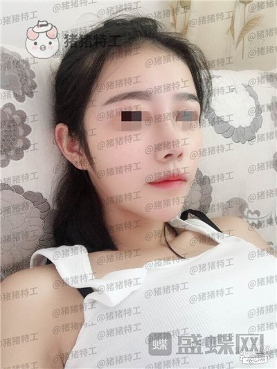 重庆铂生,杜亚旭,鼻部手术,案例,价格,