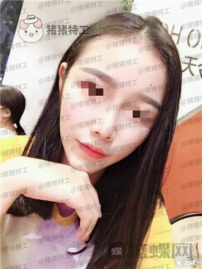 重庆铂生,杜亚旭,鼻部手术,案例,价格,