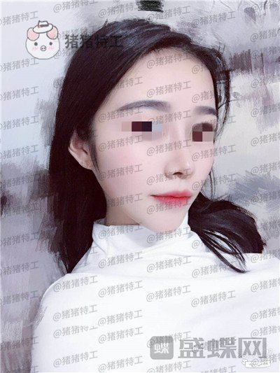 重庆铂生,杜亚旭,鼻部手术,案例,价格,