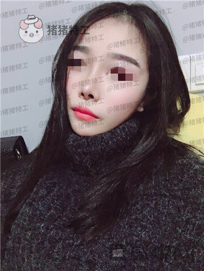 重庆铂生,杜亚旭,鼻部手术,案例,价格,