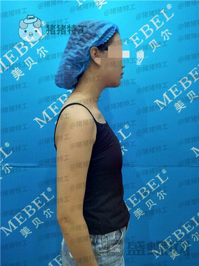 南京美贝尔,黄名斗,隆胸,案例,价格,