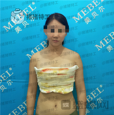 南京美贝尔,黄名斗,隆胸,案例,价格,