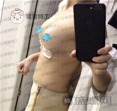 南京美贝尔,黄名斗,隆胸,案例,价格,