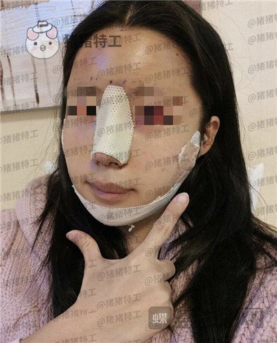 上海九院,张盈帆,隆鼻,案例,价格,