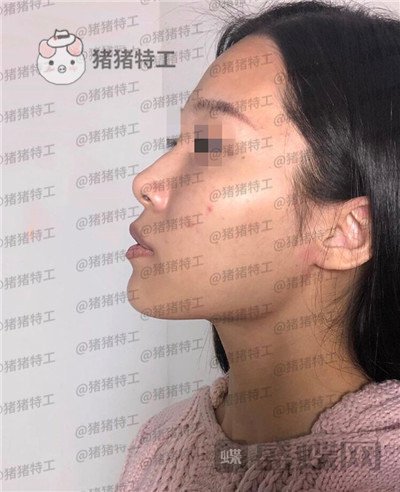 上海九院,张盈帆,隆鼻,案例,价格,