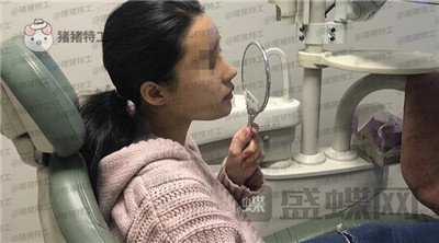 上海九院,张盈帆,隆鼻,案例,价格,