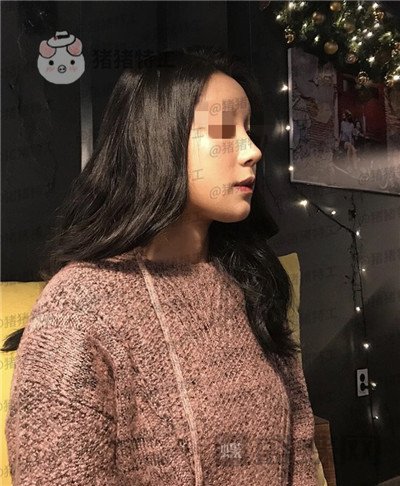 上海九院,张盈帆,隆鼻,案例,价格,