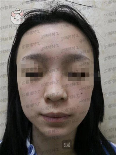 成都西区医院,车红昌,隆鼻,案例,价格,
