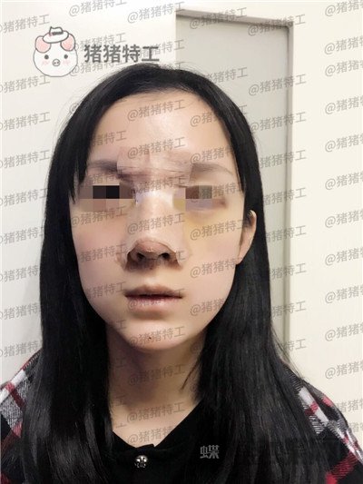成都西区医院,车红昌,隆鼻,案例,价格,