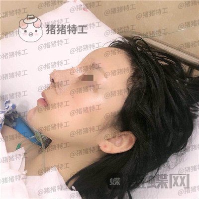 成都西区医院,车红昌,隆鼻,案例,价格,