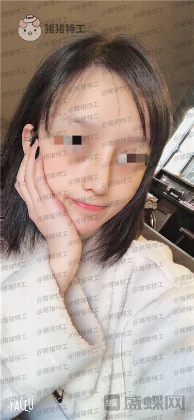 成都西区医院,车红昌,隆鼻,案例,价格,