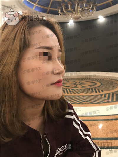 北京玲珑梵宫,张燕雄,隆鼻,案例,价格,
