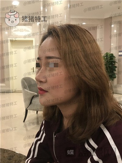 北京玲珑梵宫,张燕雄,隆鼻,案例,价格,