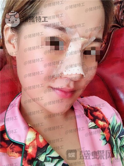 北京玲珑梵宫,张燕雄,隆鼻,案例,价格,