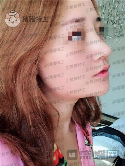 北京玲珑梵宫,张燕雄,隆鼻,案例,价格,