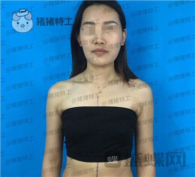 郑州集美,赵亮,隆胸,案例,价格,