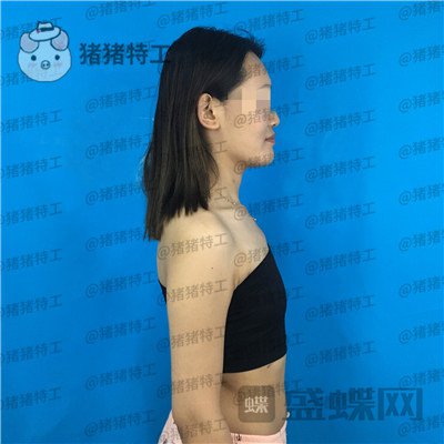 郑州集美,赵亮,隆胸,案例,价格,