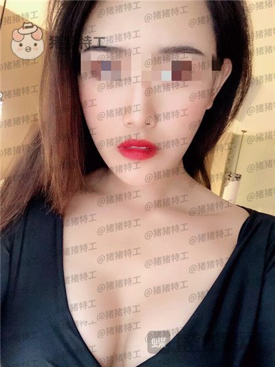 郑州集美,赵亮,隆胸,案例,价格,