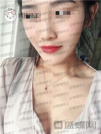 郑州集美,赵亮,隆胸,案例,价格,