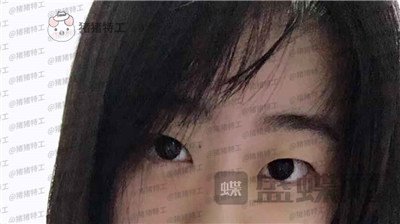 昆明悦格,陈玉琼,双眼皮,案例,价格,