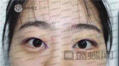 昆明悦格,陈玉琼,双眼皮,案例,价格,