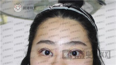 昆明悦格,陈玉琼,双眼皮,案例,价格,