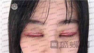 昆明悦格,陈玉琼,双眼皮,案例,价格,