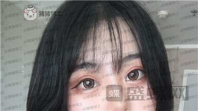 昆明悦格,陈玉琼,双眼皮,案例,价格,